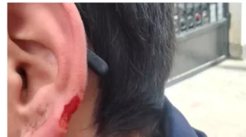 طالب يفقد جزءًا من أذنه إثر مشاجرة مع زميله داخل مدرسة بالإسكندرية